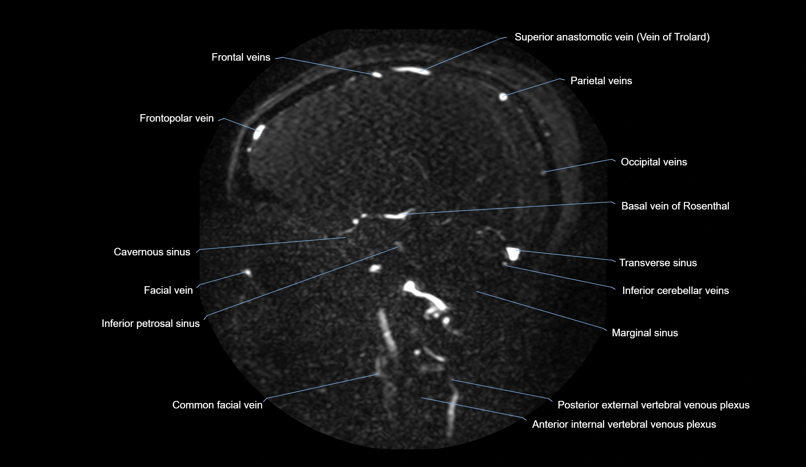 MRV brain sagittal anatomy 3T MRI images -img-01015-00053.webp